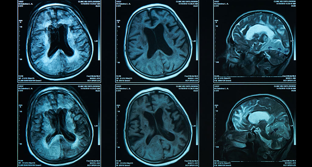 Instantané du scanner cérébral d’une personne âgée sur film d’imagerie par résonance magnétique (IRM), pour le diagnostic médical neurologique des maladies du cerveau