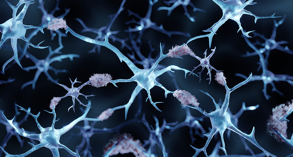 Plaques amyloïdes dans la maladie d'Alzheimer
