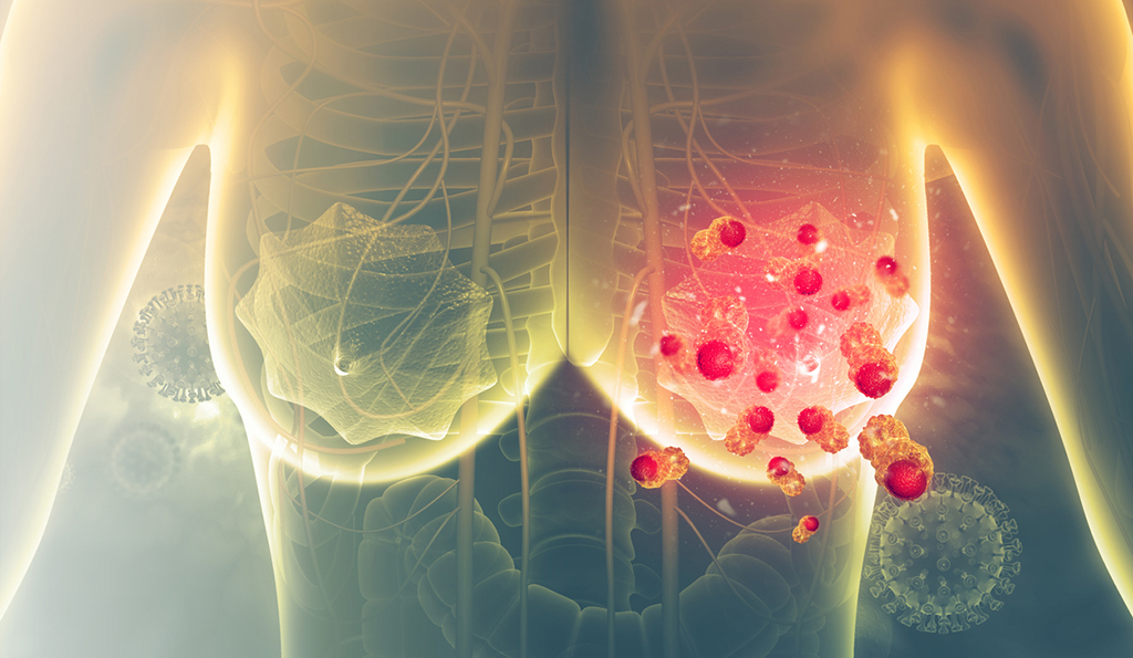 Modélisation en 3D du cancer du sein
