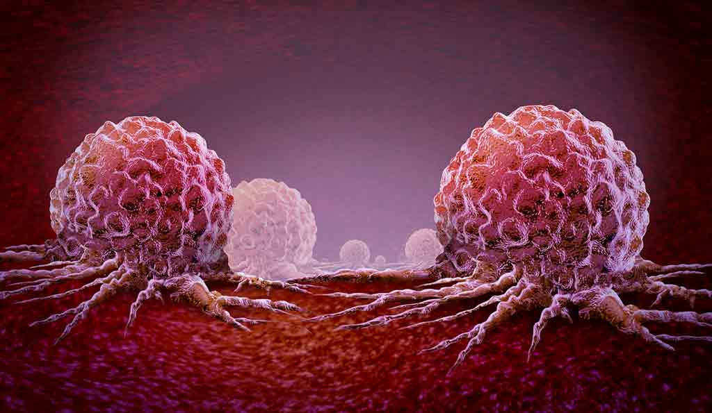 Cellules cancéreuses malignes